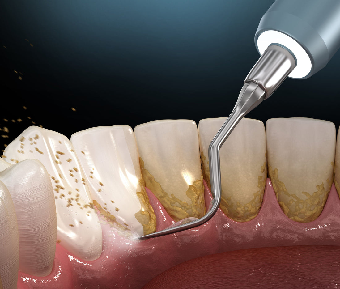 Remoção de Tártaro e Biofilme com Ultrassom Cavitador: conforto e eficiência na profilaxia profunda